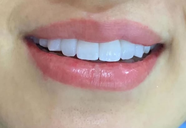 Smile Makeovers